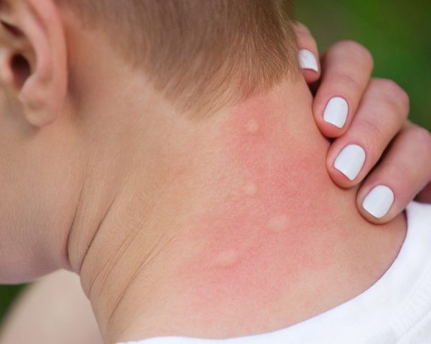 Что делать, если у вас аллергия на укусы комаров и мошек