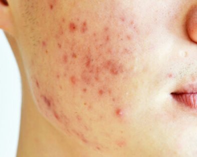 Как избавиться от постакне