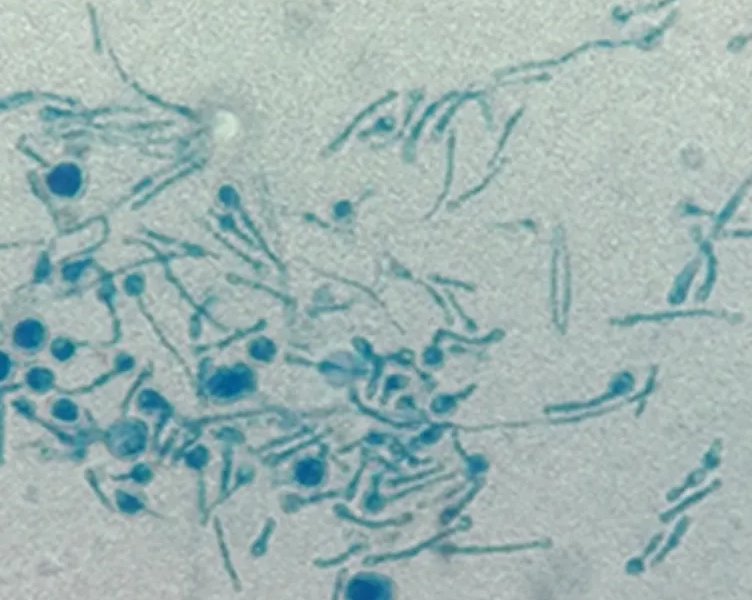 Смертельный для деревьев грибок впервые выявили у человека