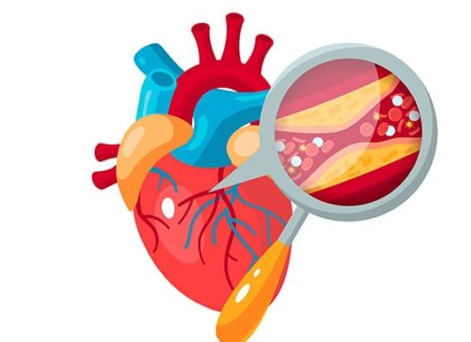 Атеросклероз аорты сердца: причины, симптомы, лечение народными средствами и медикаментами Атеросклероз аорты сердца: причины, симптомы, лечение народными средствами и медикаментами