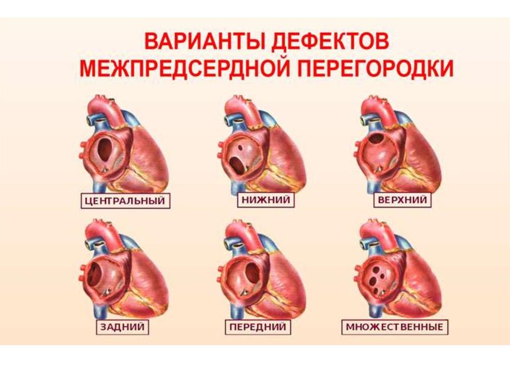 Дефекты межпредсердной перегородки: виды, симптомы и лечение